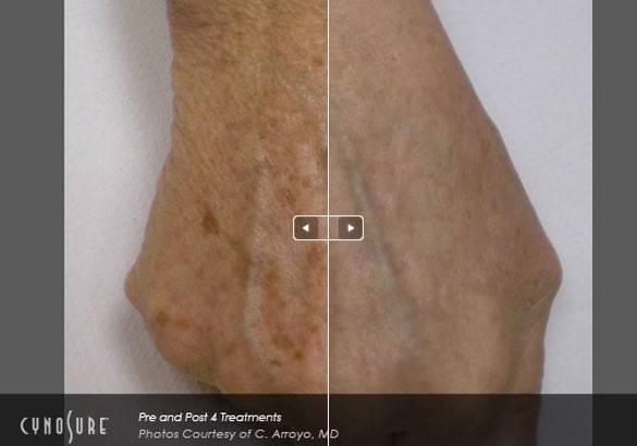 Before and After IPL Photofacial Sarasota FL