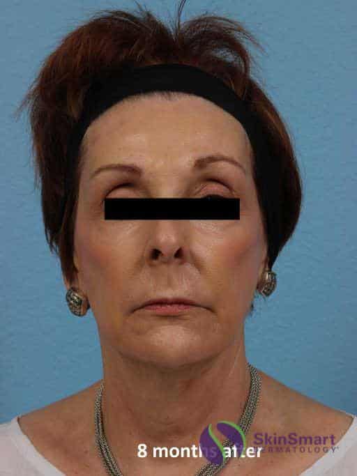 After Ultherapy Sarasota FL