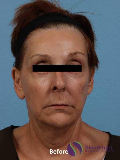 Before Ultherapy Sarasota FL