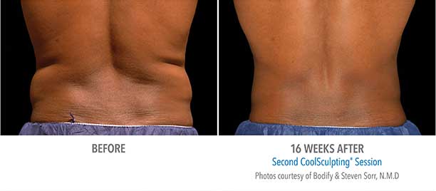 Lower Back Region CoolSculpting Before and After Sarasota FL