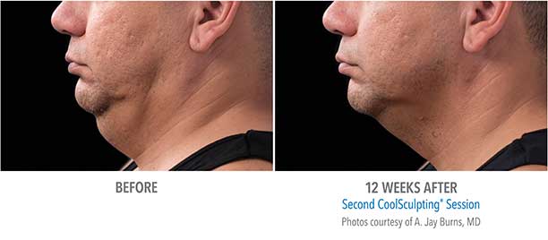 Chin Region CoolSculpting Before and After Sarasota FL