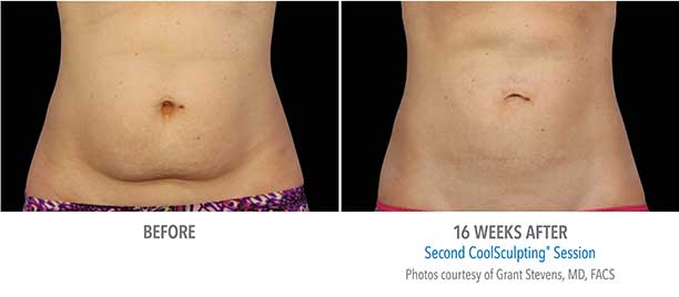 Abdominal Region CoolSculpting Before and After Sarasota FL