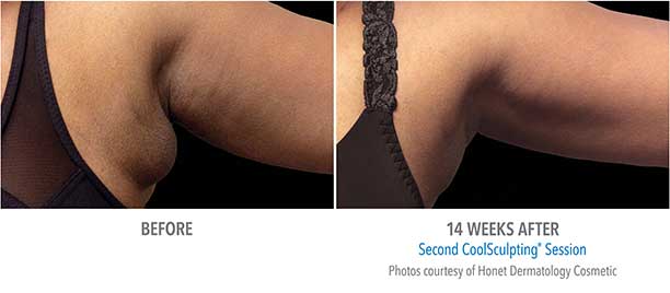 Upper Arms CoolSculpting Before and After Sarasota FL