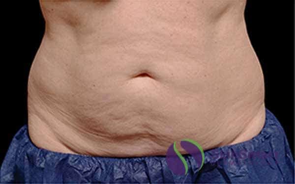 Before CoolSculpting Sarasota FL