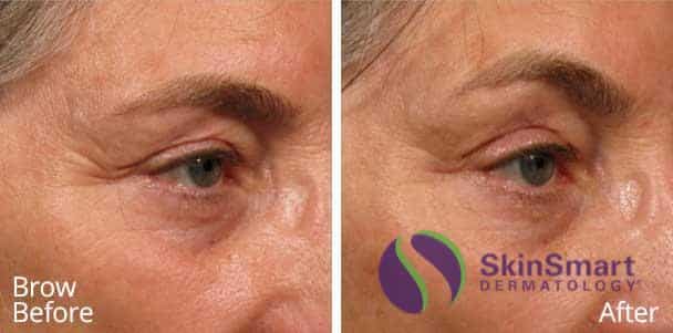 Brow Ultherapy Before and After Florida