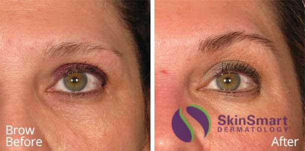 Brow Ultherapy Before and After Sarasota FL