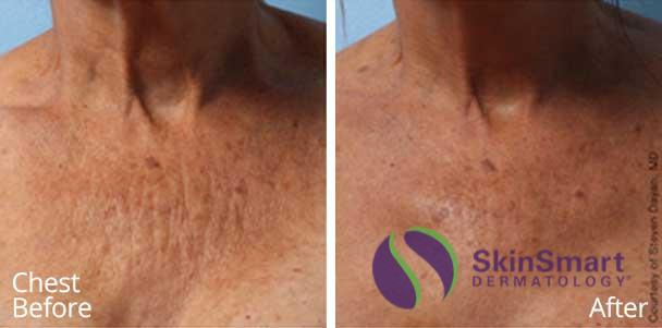 Chest Ultherapy Before and After Sarasota FL
