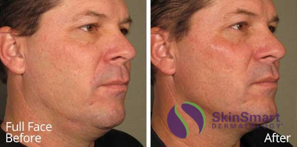 Full Face Ultherapy Before and After Sarasota FL
