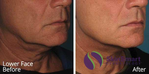 Lower Face Ultherapy Before and After Florida
