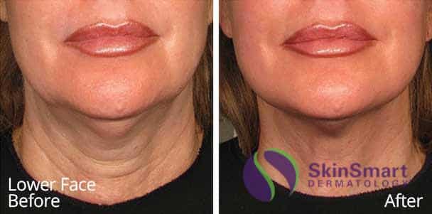 Lower Face Ultherapy Before and After Sarasota FL