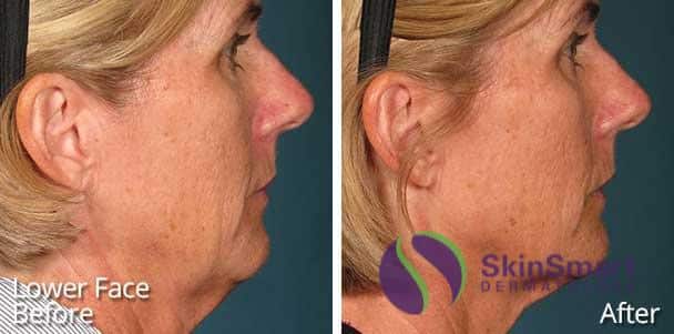Lower Face Ultrasound Therapy Before and After Sarasota FL