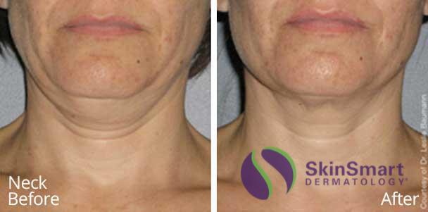 Neck Ultherapy Before and After Sarasota FL