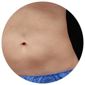 CoolSculpting Fat Reduction Sarasota FL