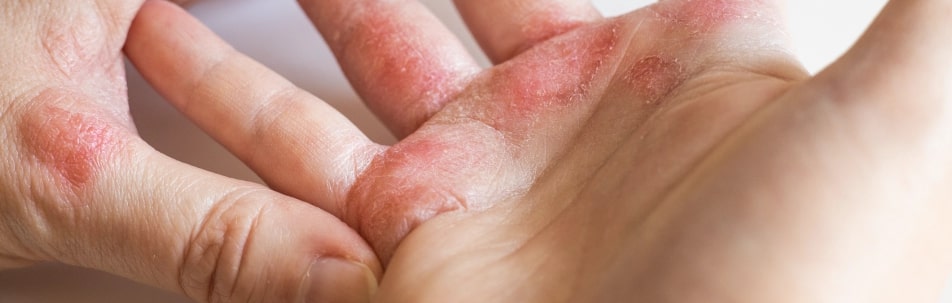 Eczema Treatment Sarasota FL