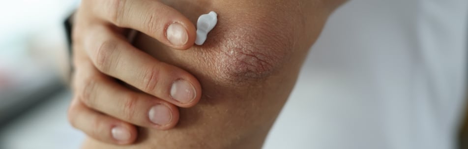 Psoriasis Treatment Sarasota FL