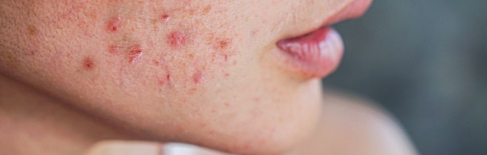 Acne Treatment Sarasota FL