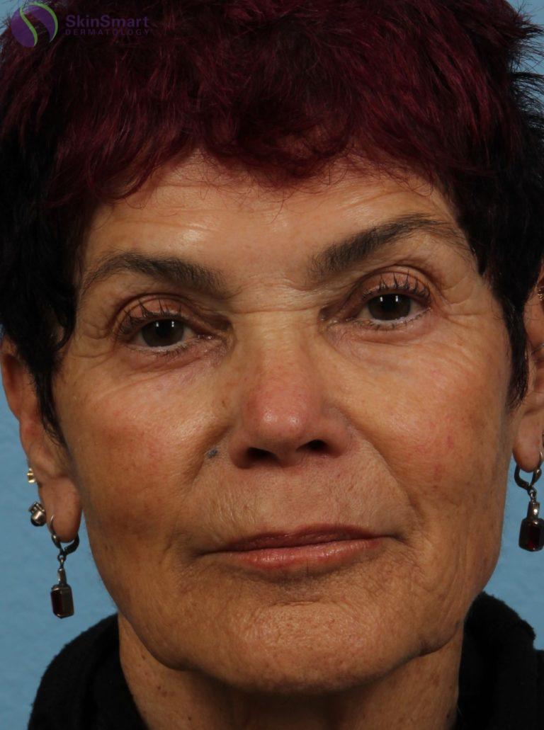 After Image: Restylane - front