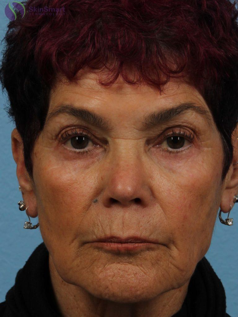 Before Image: Restylane - front