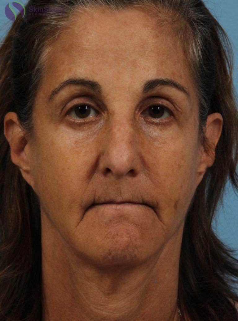 Before Image: Restylane - front