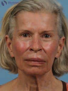 After Image: Deka Dot Laser Resurfacing
