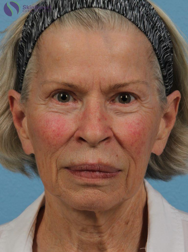 Before Image: Deka Dot Laser Resurfacing - front