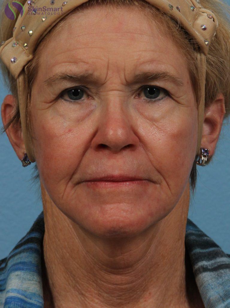 After Image: Deka Dot Laser Resurfacing - front
