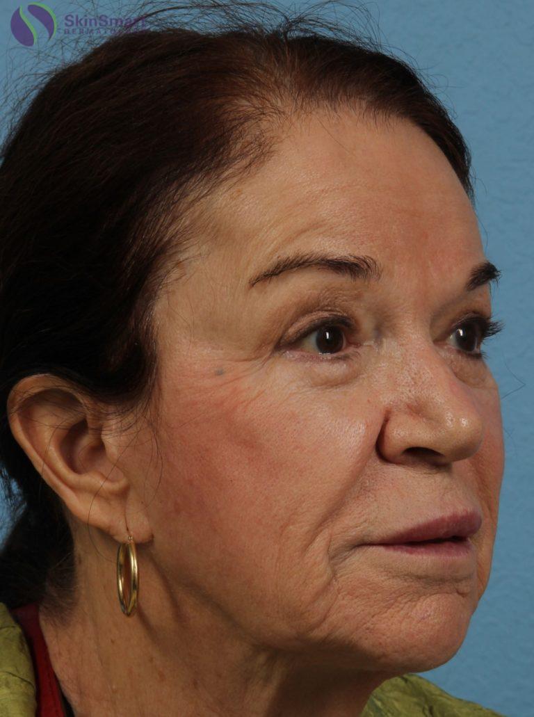 After Image: Dermal Fillers - front