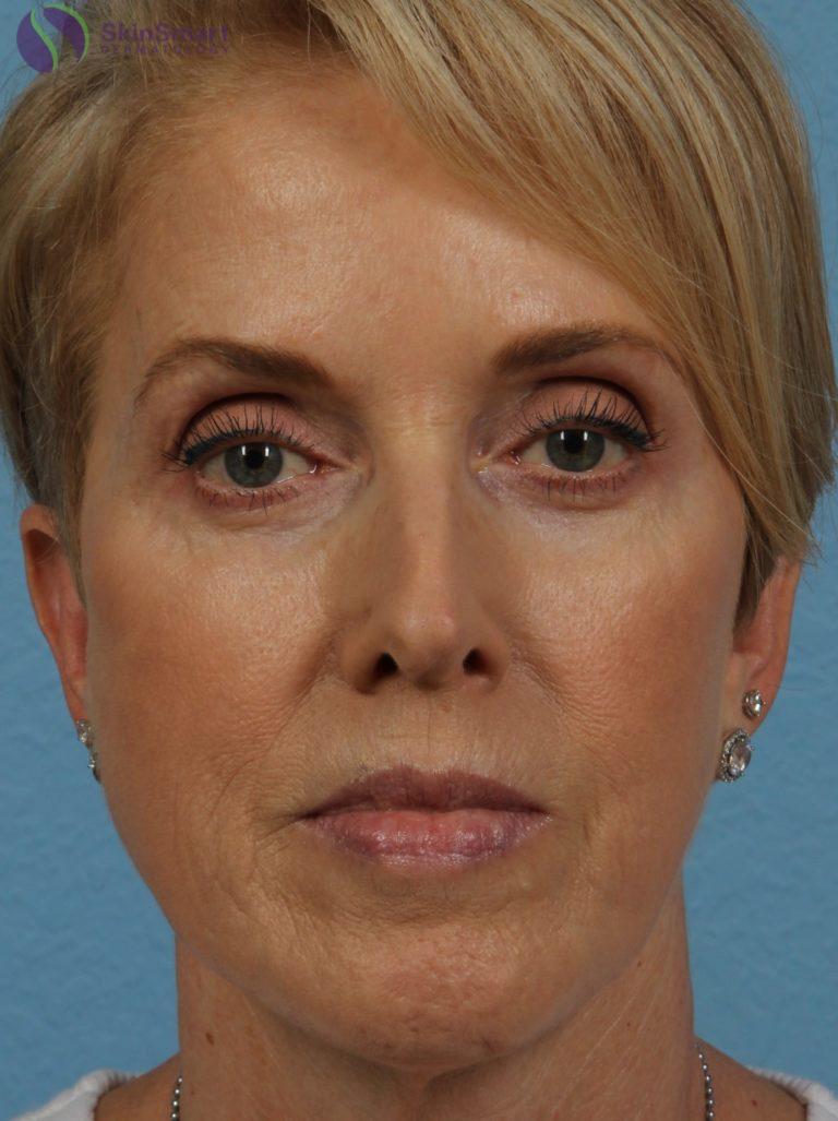After Image: Dermal Fillers - front