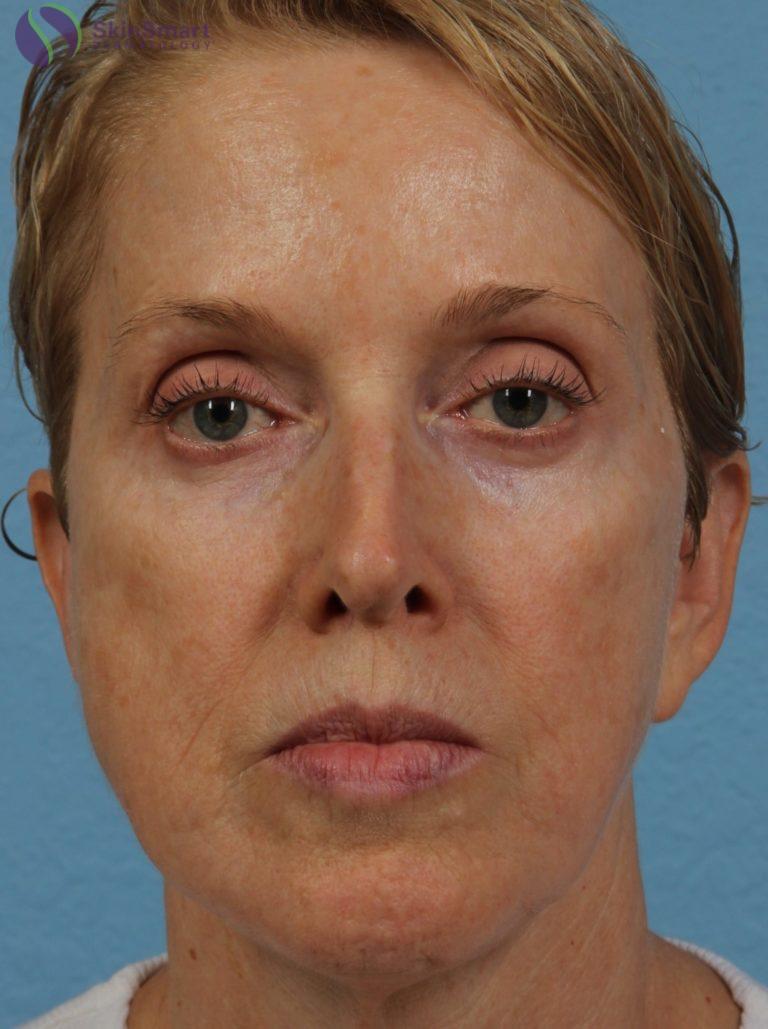 Before Image: Dermal Fillers - front