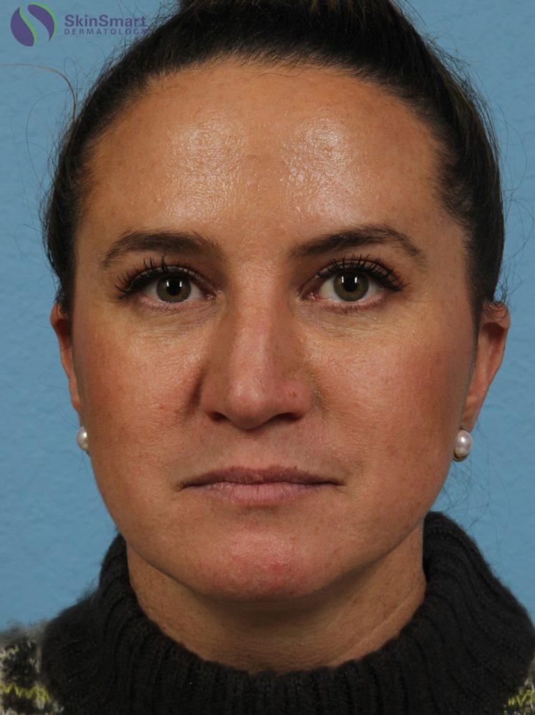 Before Image: Lip Filler - front