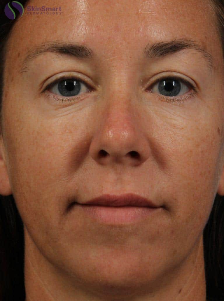 After Image: Restylane - front