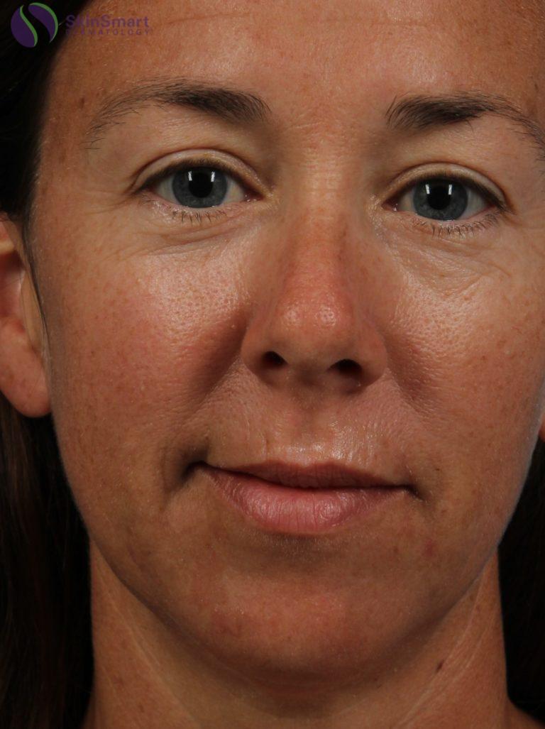 Before Image: Restylane - front
