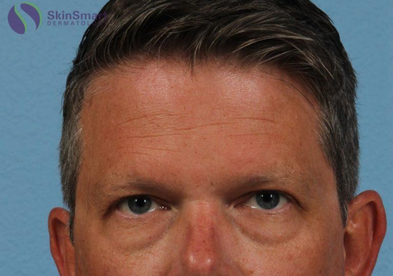 Before Image: Under Eye Circles - front