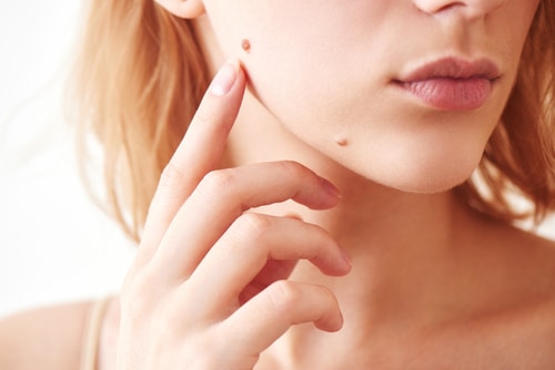 The mole on the girls face closeup