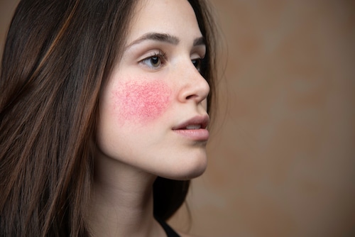 Woman with rosacea