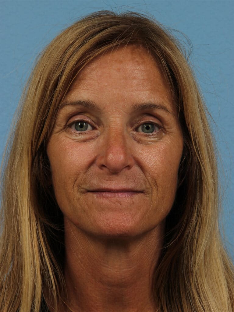 Before Image: Restylane - front