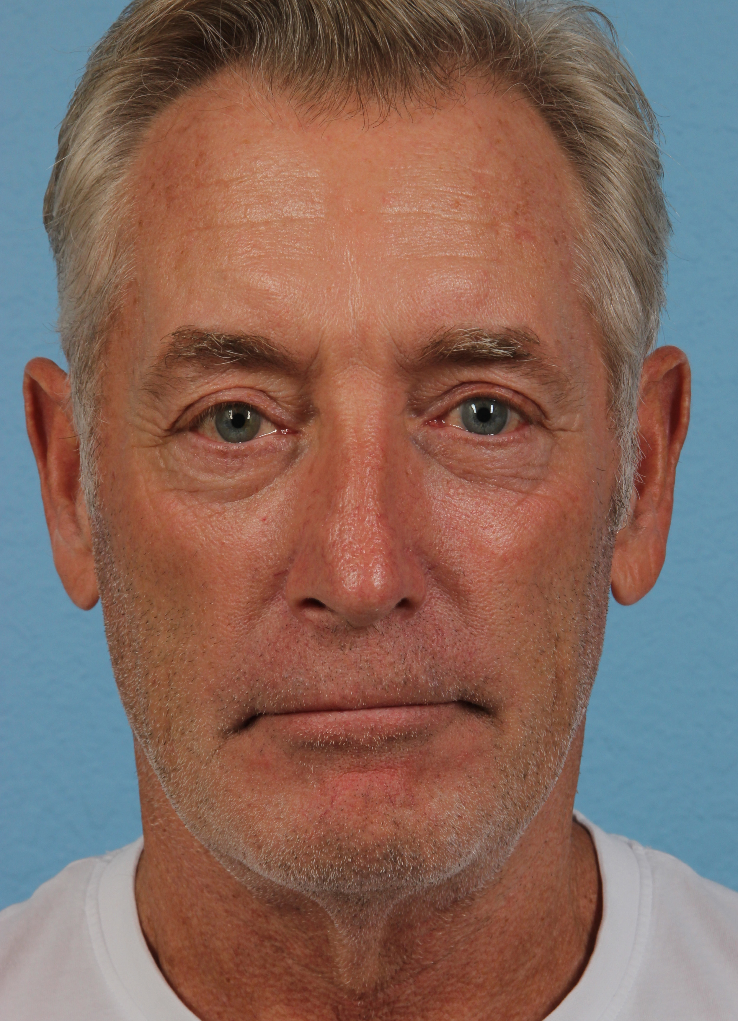 After Image: Tear Troughs and Cheeks Filler - front