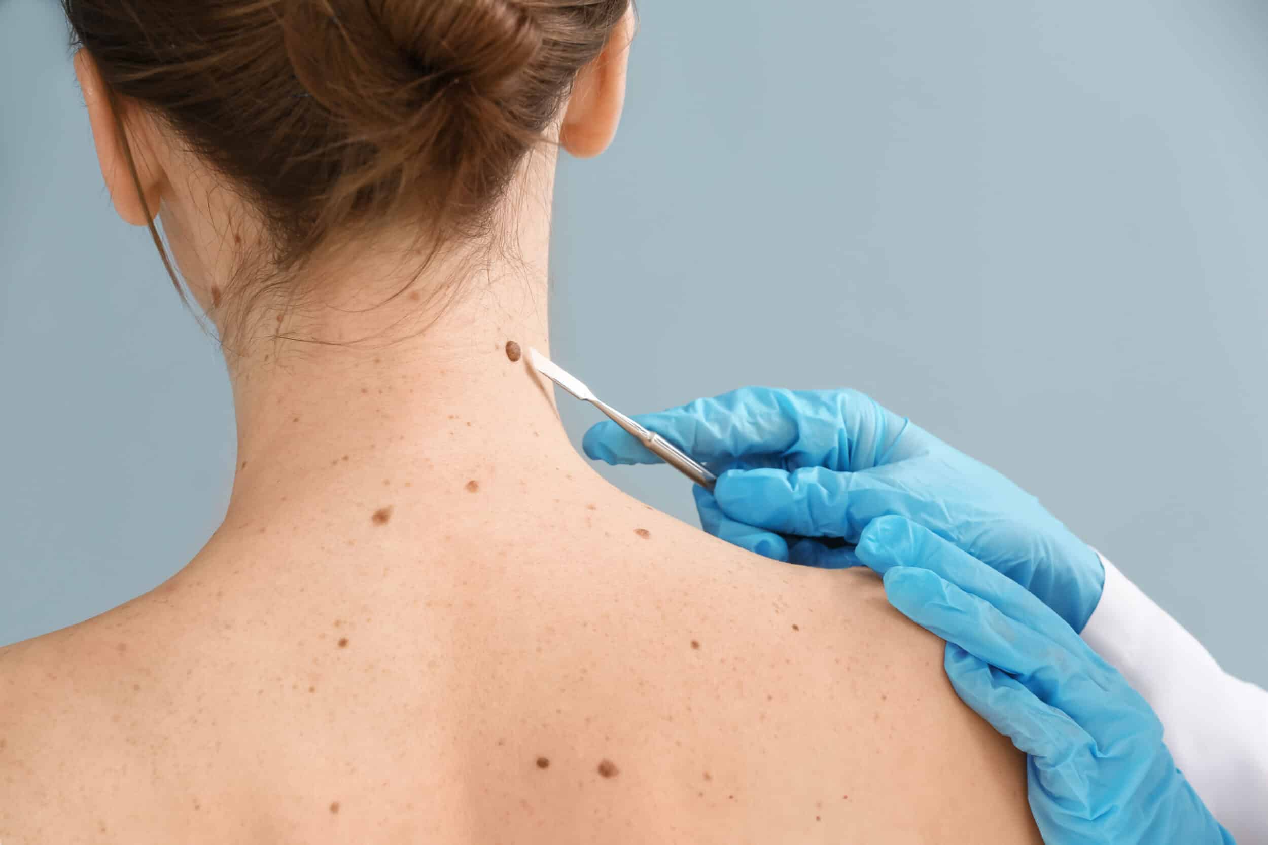 Skin Cancer Treatments FL