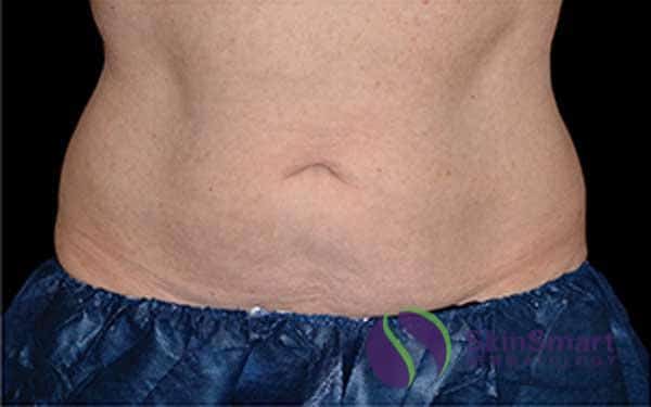 After CoolSculpting Sarasota FL