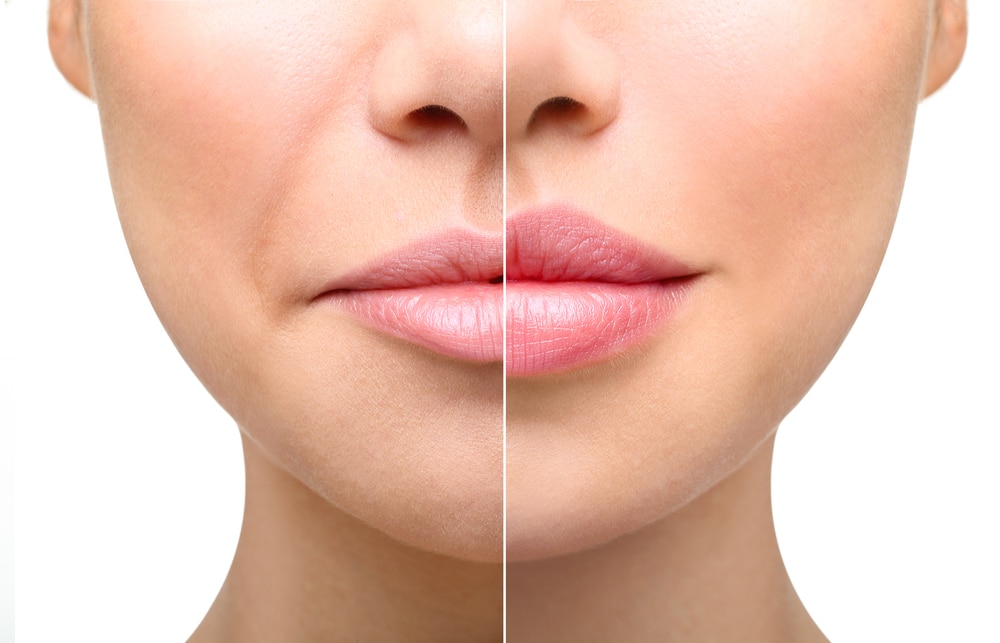 Before and after treatment of facial volume loss in Sarasota, FL