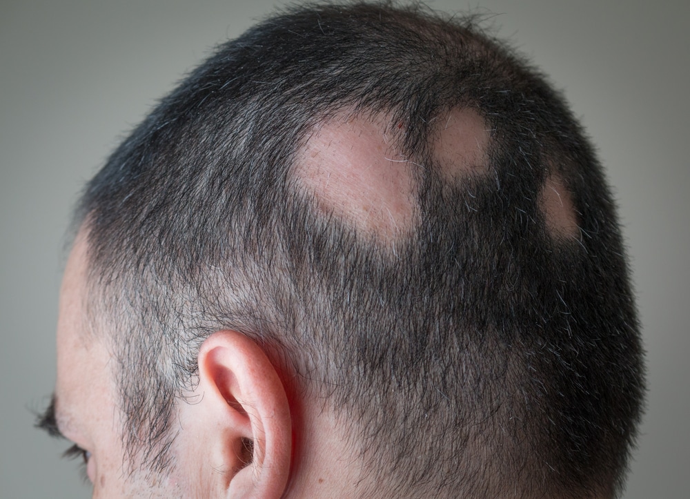 Man with alopecia areata in Sarasota, FL