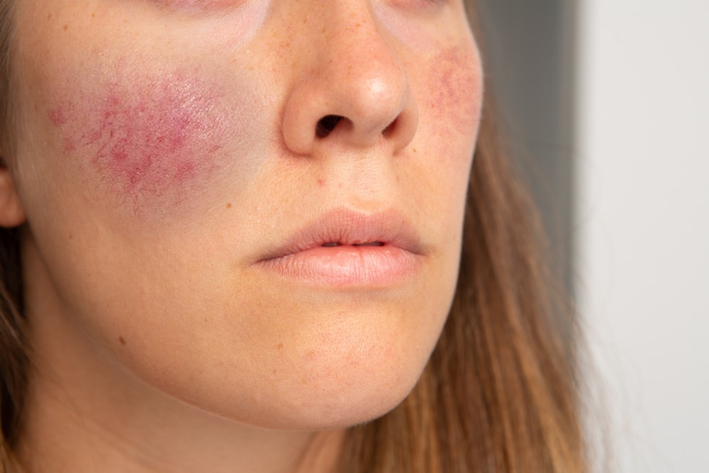 Laser Therapy Sarasota FL