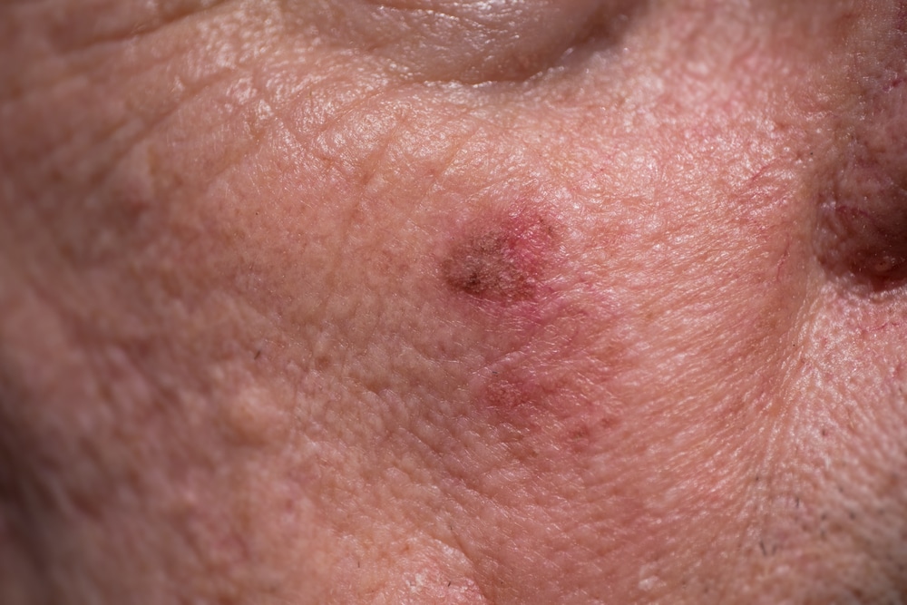 Skin Cancer Care FL