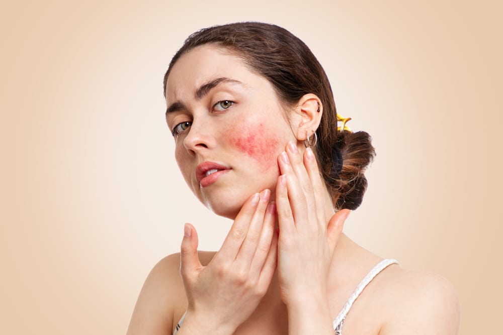 A woman with rosacea on her cheek