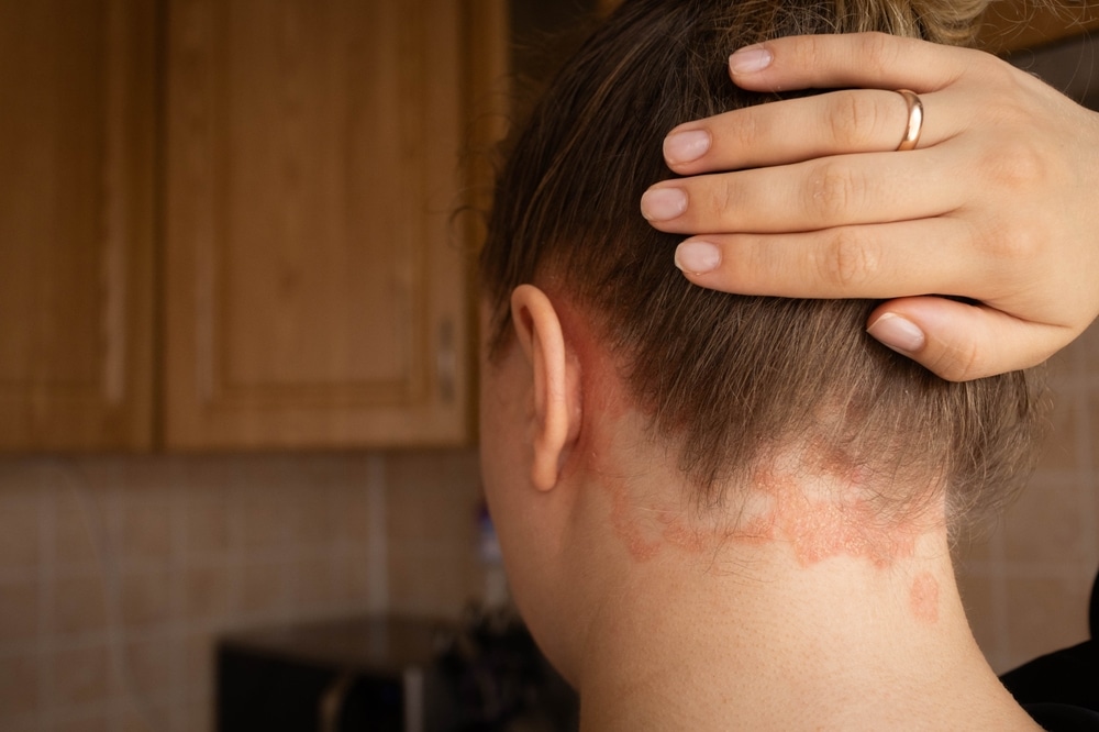 Topical Treatment Sarasota FL
