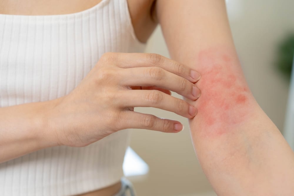 Atopic Dermatitis Sarasota