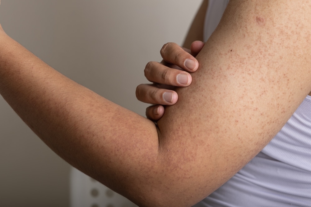 A close-up shot of keratosis pilaris on a woman's arm