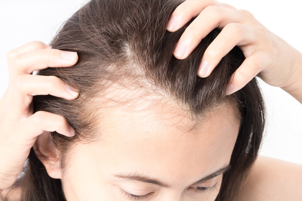 Alopecia Sarasota FL