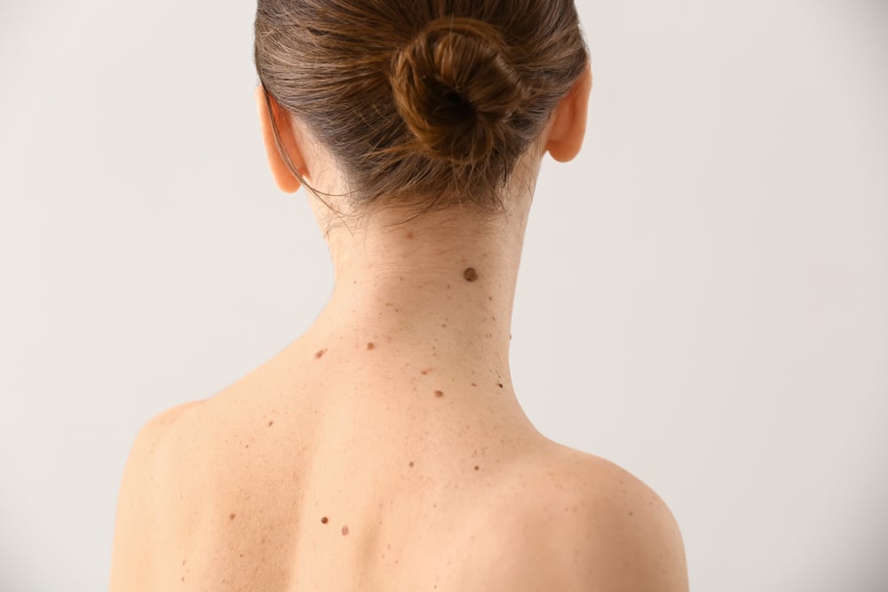 Mole Removal Sarasota FL