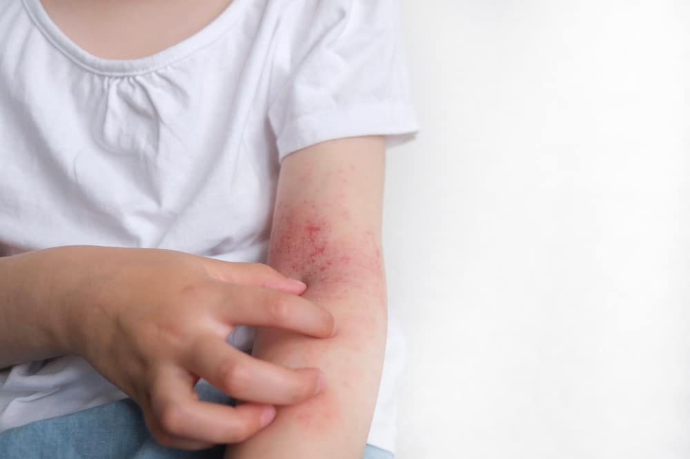 Child scratching atopic skin with visible signs of dermatitis, diathesis, allergy, or fungal infection on the body.